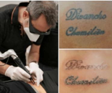 Verwijderen tattoo met Laser Alec voorbeeldfoto