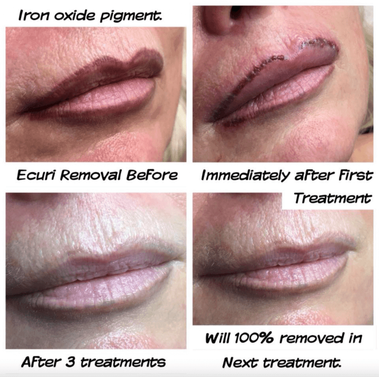 Lippen laseren voor na collage voorbeeldfoto