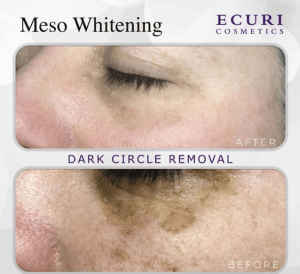 Meso Whitening foto resultaat dark circles voor / na
