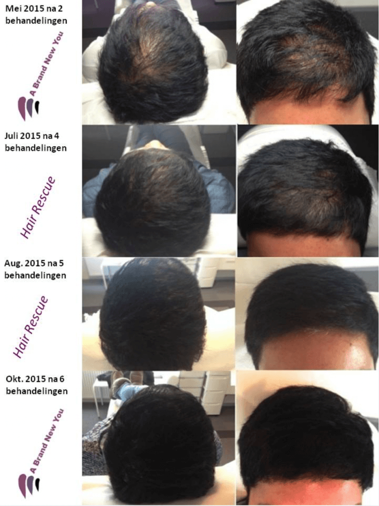 Hair Rescue Program Overzicht foto's per behandeling
