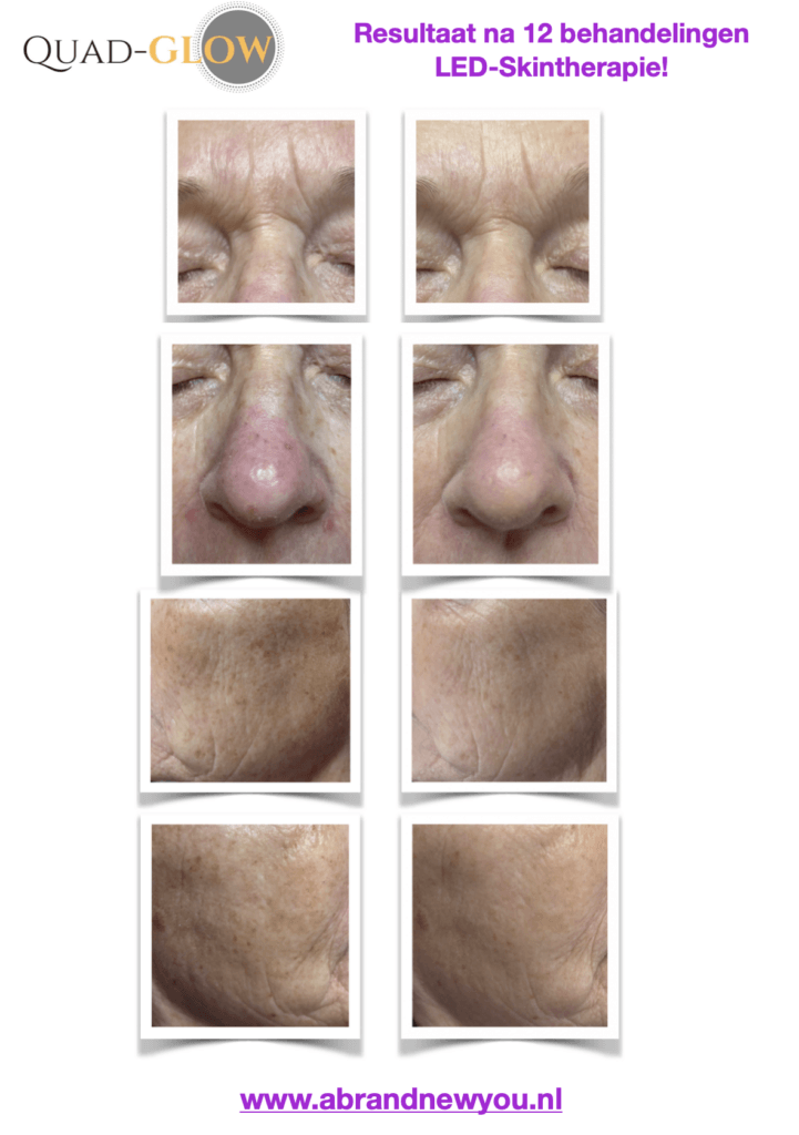 LED 12 x rosacea