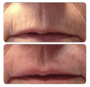 Microneedling en dryneedling vb Ecuri