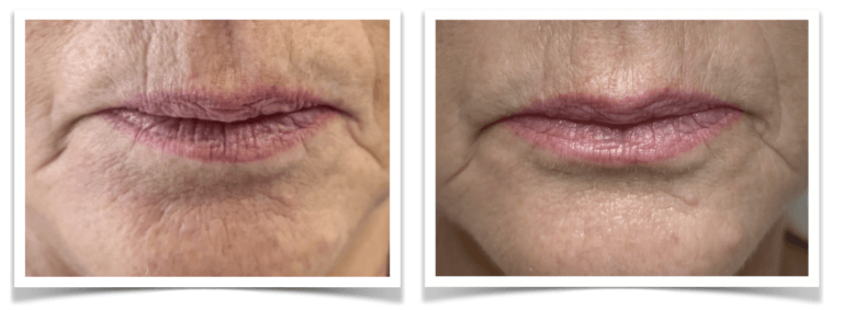 Micro Anti-age en Dry Wil 3x mond