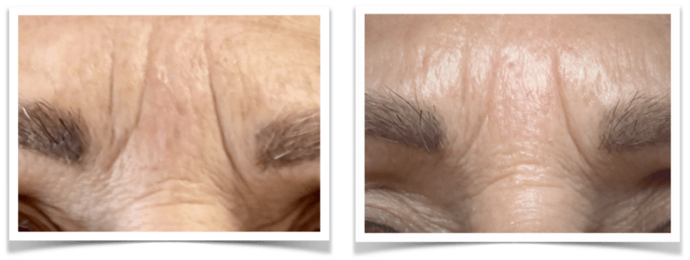 Micro Anti-age en Dry Wil 3x frons