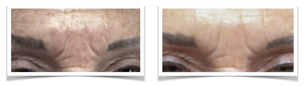 Corina 4X MN Anti-age, PDRN en DryNeedle