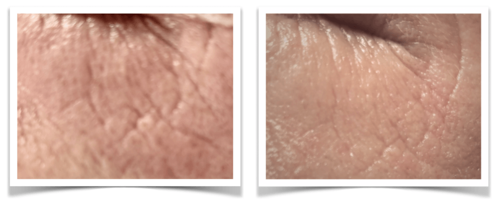Corina2 4X MN Anti-age, PDRN en DryNeedle