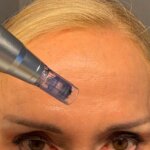 Voorbeeld voorhoofd Microneedle