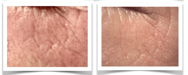 Corina mondhoek 4X MN Anti-age, PDRN en DryNeedle