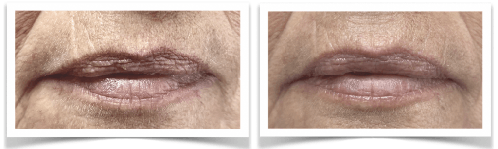 Melanie Mond 4 x Anti age en Dryneedle