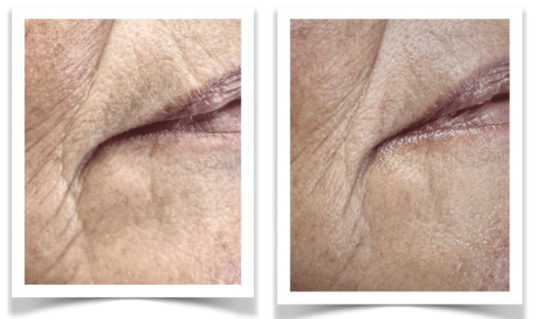 Melanie Mondhoek 4 x Anti age en Dryneedle