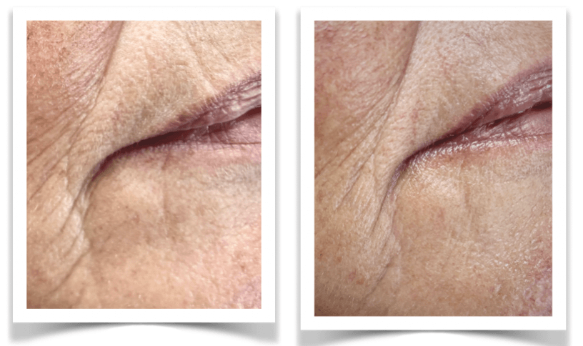 Melanie Mondhoek 4 x Anti age en Dryneedle