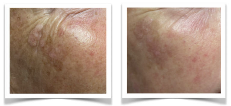 Sonja 4x Anti age met PDRN
