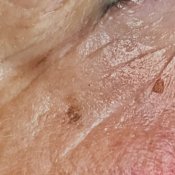 Foto YdG pigmentvlek / ouderdomsvlek voor laserbehandeling A Brand New You