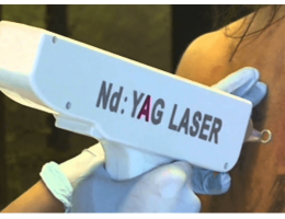 Nd Yag Laser