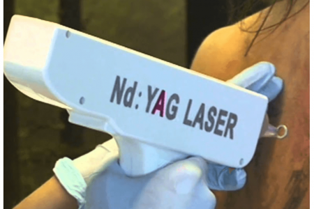Nd Yag Laser